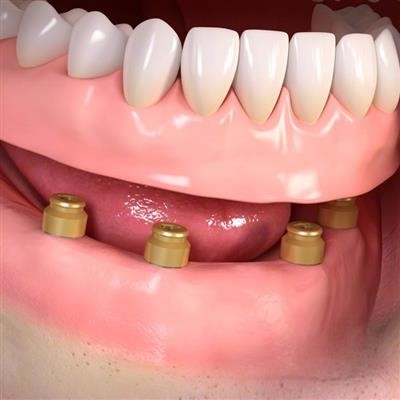 Zirconia Dentures Como TX 75431